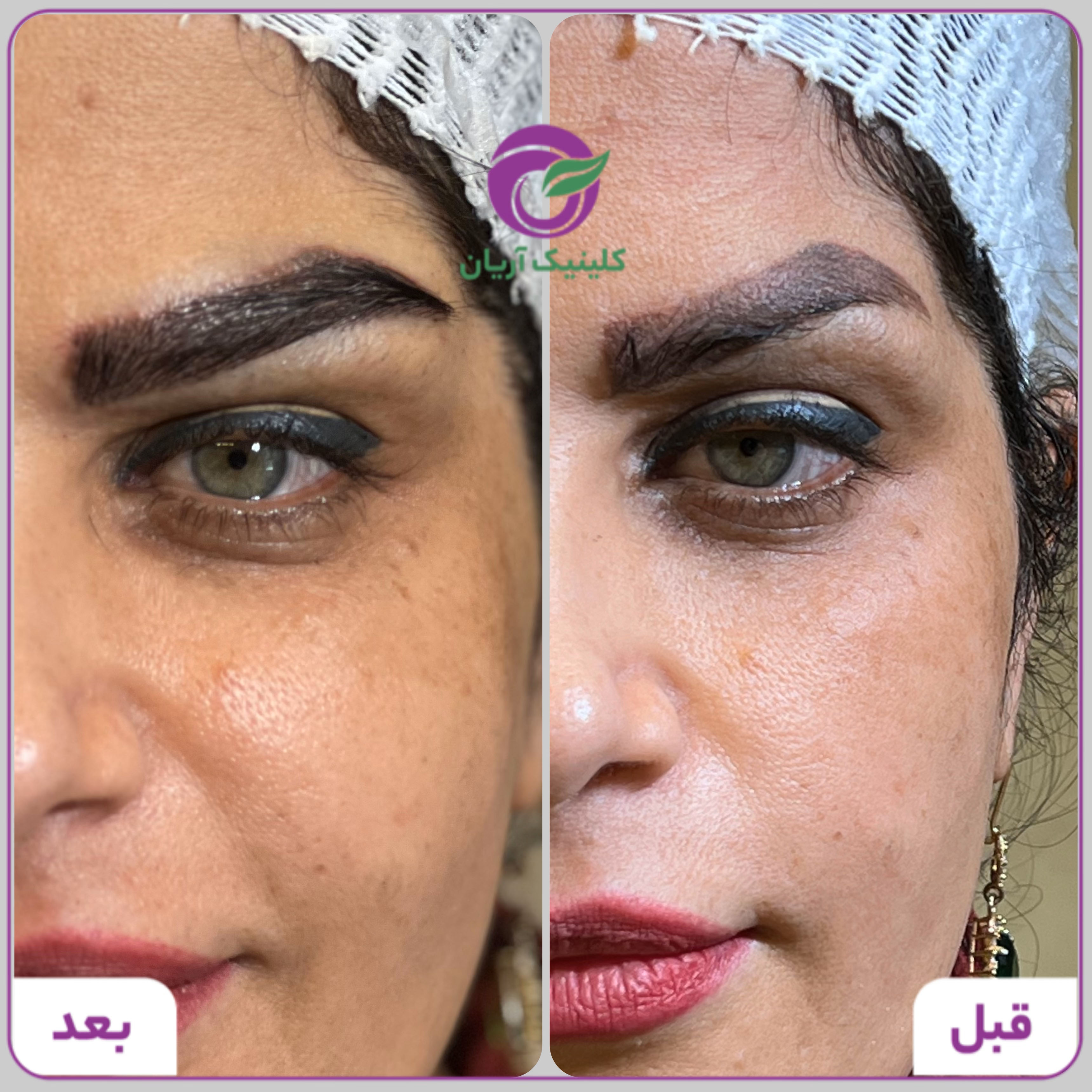 گالری فیلم کاشت ابرو